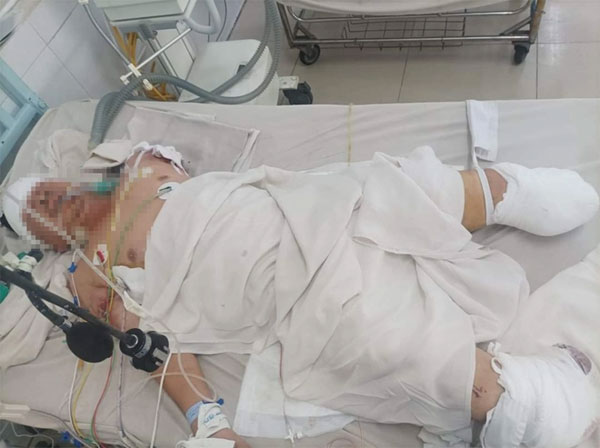 Nam công nhân Bình Phước mất 1 tay, 2 chân vì cuốn vào máy trộn-1