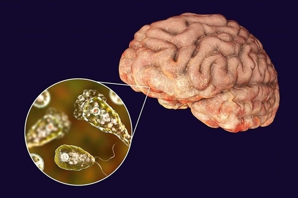 Khó thở, tràn dịch màng phổi do sán ký sinh-2