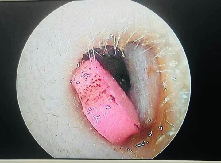 Bé 6 tuổi sốt nhập viện, bác sĩ phát hiện cục tẩy trong tai-1