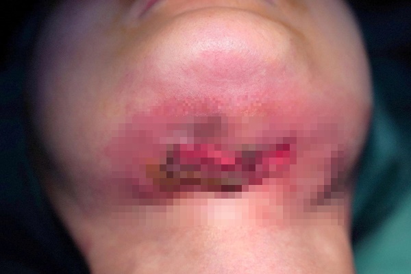 Tiêm tan mỡ nọng cằm, nhiều người bị biến chứng nhiễm trùng, áp xe-3