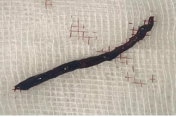 Người đàn ông đột quỵ sau khi giác hơi tại nhà-2