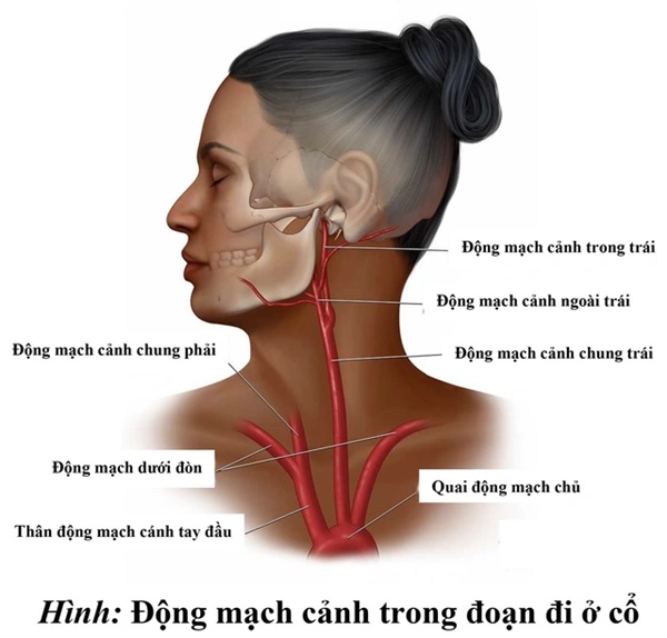 Người đàn ông đột quỵ sau khi giác hơi tại nhà-3
