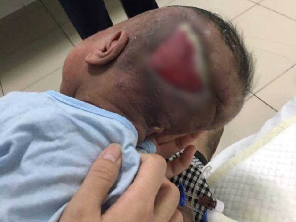 Ánh mắt cầu cứu của bé trai 5 tháng tuổi toàn thân lở loét vì căn bệnh quái ác-3