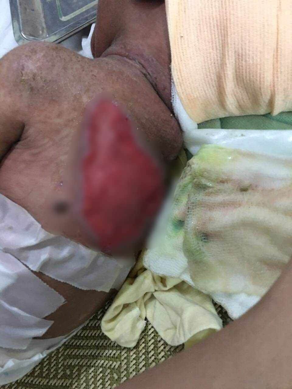 Ánh mắt cầu cứu của bé trai 5 tháng tuổi toàn thân lở loét vì căn bệnh quái ác-4