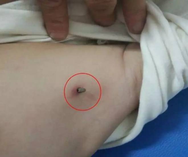 Con bị côn trùng cắn, một hành động của người mẹ suýt chút nữa khiến đứa trẻ ra đi mãi mãi-1