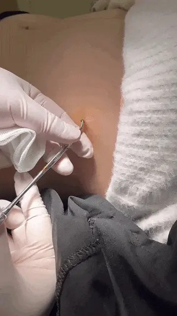 Con bị côn trùng cắn, một hành động của người mẹ suýt chút nữa khiến đứa trẻ ra đi mãi mãi-2