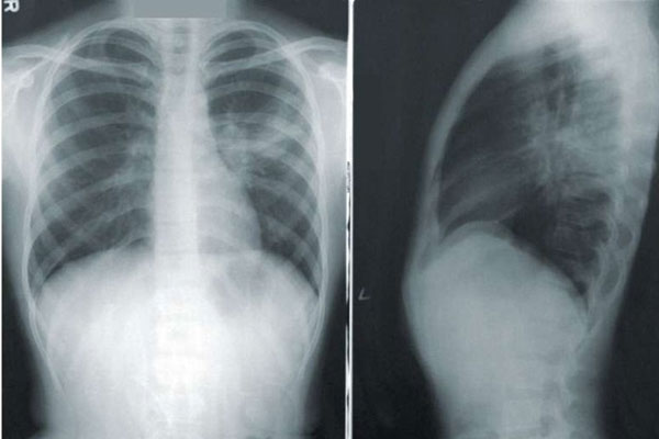 Tìm ra nguyên nhân vì sao nhiều người không bao giờ hút thuốc lá lại bị ung thư phổi-1