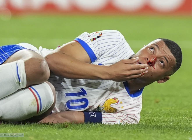Ngôi sao số 1 của tuyển Pháp chấn thương kinh dị: Gãy mũi, đổ máu, phải đi thẳng vào bệnh viện-3