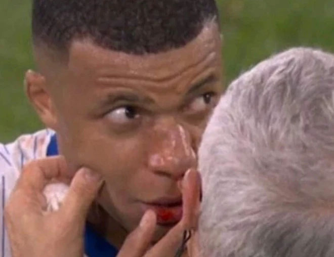 Ngôi sao số 1 của tuyển Pháp chấn thương kinh dị: Gãy mũi, đổ máu, phải đi thẳng vào bệnh viện-4