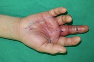 Người phụ nữ suýt phải cắt cụt ngón tay vì mắc 1 sai lầm khi lau nhà: Bác sĩ cảnh báo nguy cơ