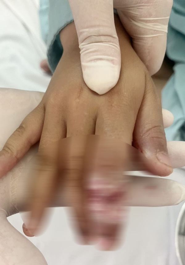 Bé trai 7 tuổi bị bỏng tay khi rút điện thoại đang sạc-1