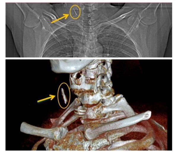 Kỳ lạ người đàn ông bị chiếc đinh rỉ sét cắm sâu trong cổ mà không biết-1