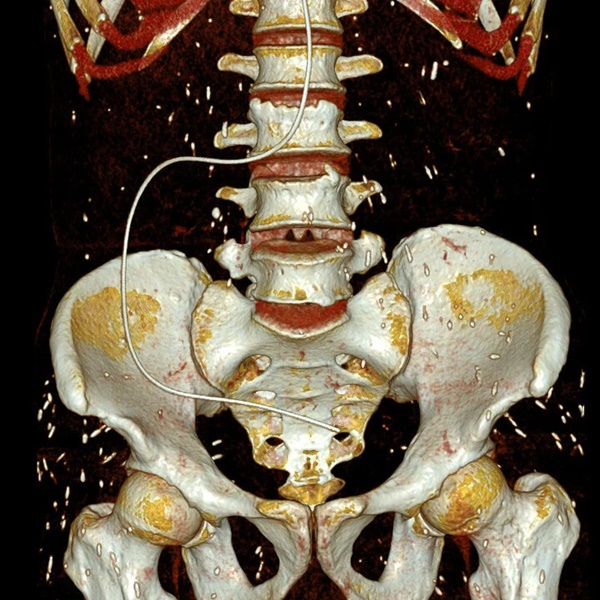 Đi khám do đau bụng, phát hiện sán ký sinh khắp cơ thể-1