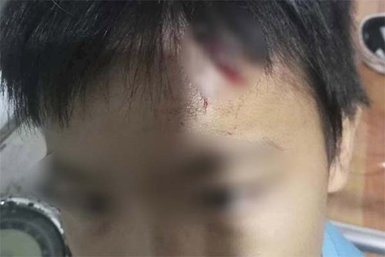 Diễn biến mới vụ mẹ kế nghi bạo hành con riêng của chồng
