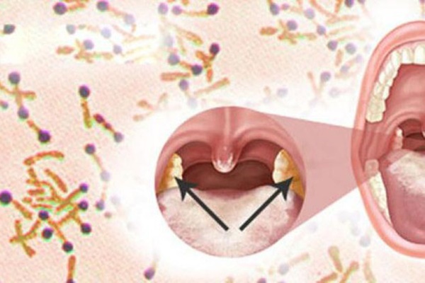 Thông tin mới nhất ổ dịch bạch hầu ở Nghệ An-3