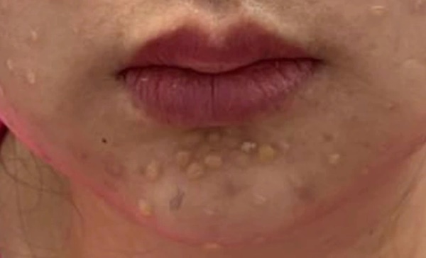 Môi sưng nề sau tiêm meso làm đẹp-2