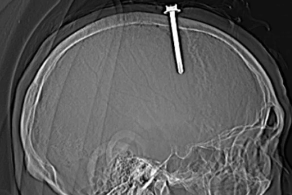 Một người ở Thanh Hóa tự đóng cây đinh dài 5 cm vào đầu mình-1