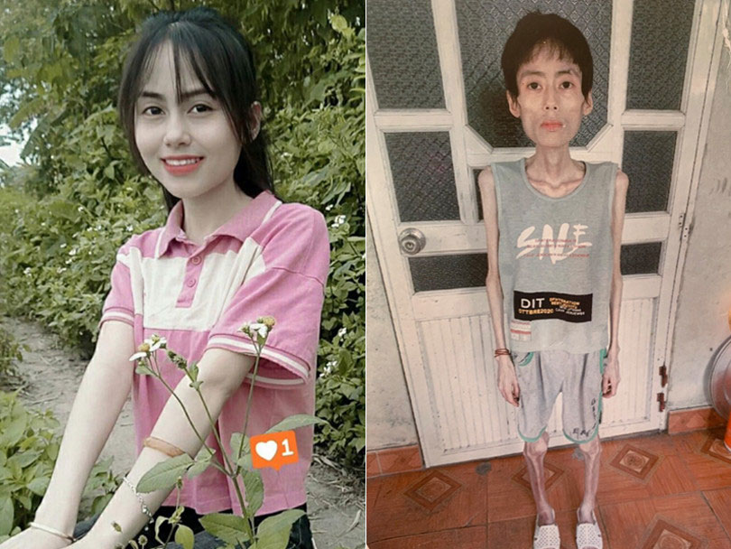 Cô gái Hưng Yên nặng 18kg sau nhiều năm không ăn cơm để giảm cân-1