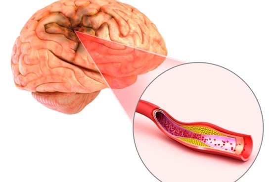 Dấu hiệu sớm của đột quỵ
