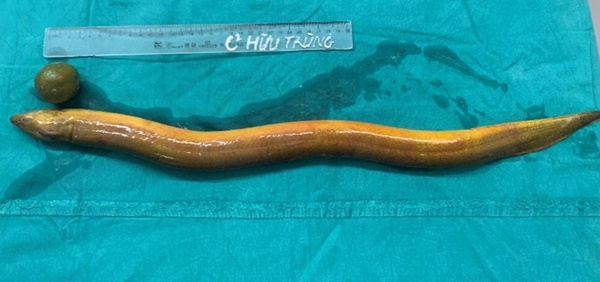 Nhét con lươn vào hậu môn, bị cắn thủng trực tràng-2