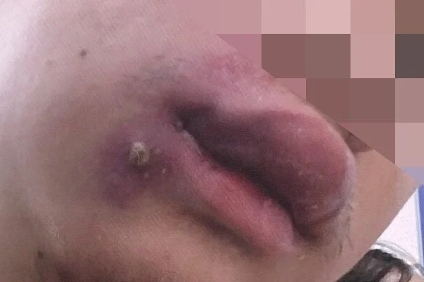 Nhập viện cấp cứu sau khi tự nặn mụn-1