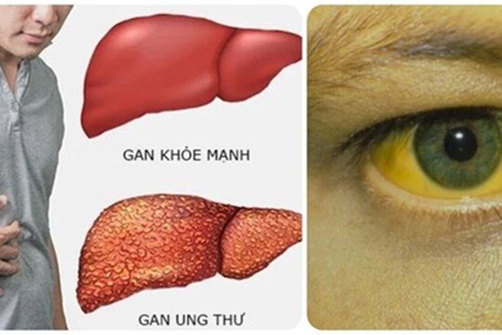 9 dấu hiệu cảnh báo ung thư gan phổ biến nhất