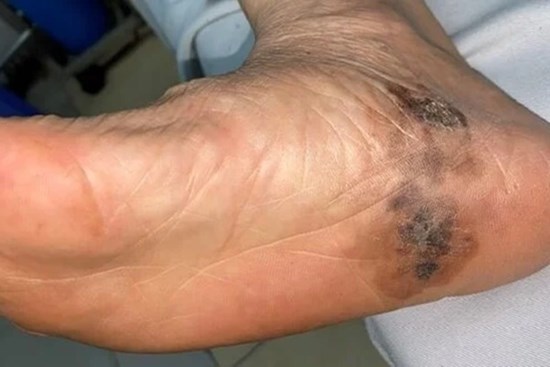 Vết đen lạ ở gót chân nhiều năm, không ngờ mắc ung thư