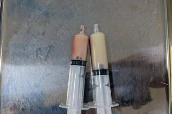 Cấp cứu người đàn ông bị mỡ máu 'đông đặc'