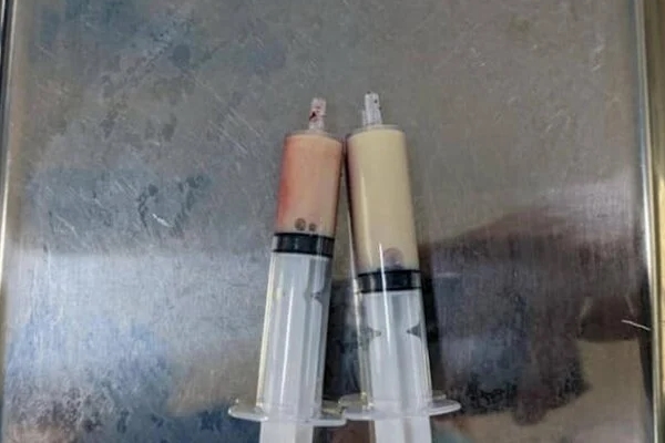 Cấp cứu người đàn ông bị mỡ máu đông đặc-1