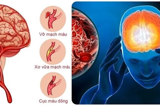 7 dấu hiệu cảnh báo cơn đột quỵ sắp xảy ra