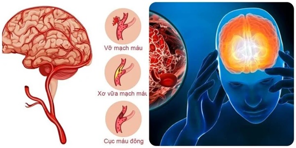 7 dấu hiệu cảnh báo cơn đột quỵ sắp xảy ra-1