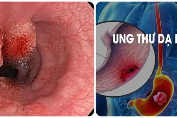 7 dấu hiệu ung thư dạ dày thường gặp nhất không nên bỏ qua-1