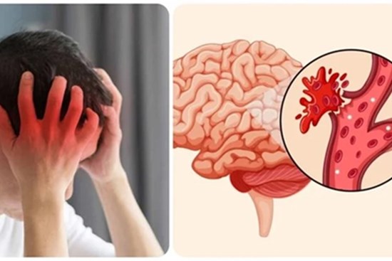 6 thói quen xấu dễ gây đột quỵ mùa hè, nhiều người không biết vẫn làm