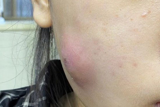 Suýt hoại tử mặt do tự ý nặn mụn