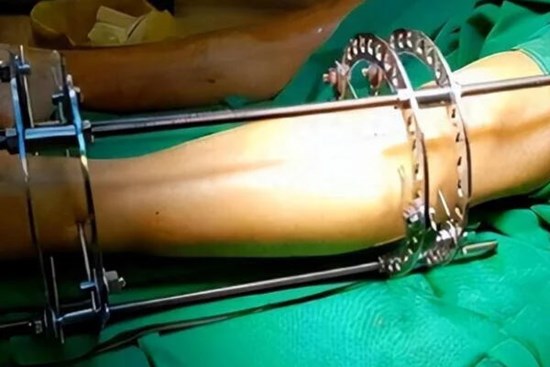 Cô gái thấy 'cuộc đời bị hủy hoại' sau khi chi 2,1 tỷ đồng kéo dài chân