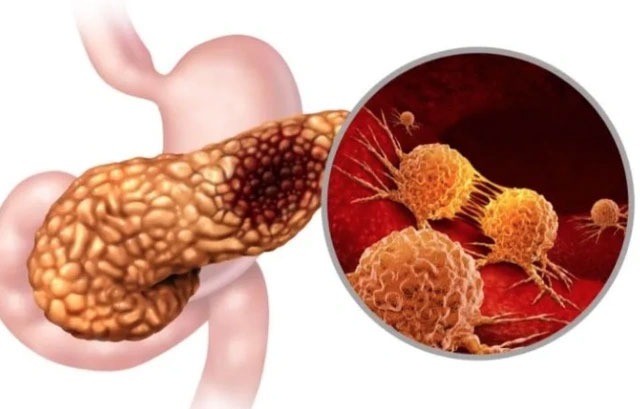 Người phụ nữ bị ung thư tuyến tuỵ không rượu bia thuốc lá nhưng thừa nhận thường xuyên ăn món này-2