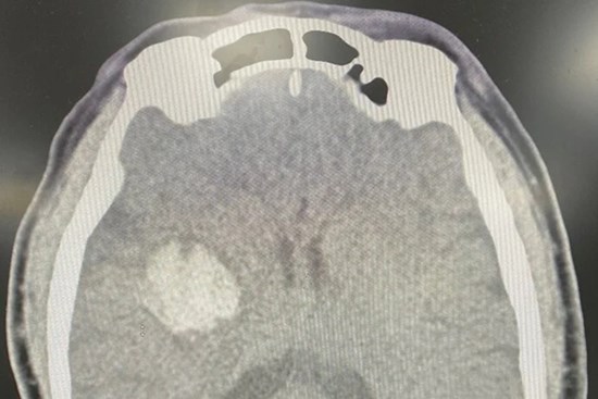 Nguy kịch sau uống thuốc an cung ngưu chữa đột qụy