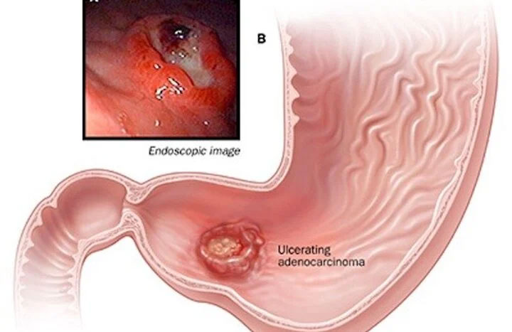 Dấu hiệu cảnh báo bạn có thể bị ung thư dạ dày cần khám sớm-1