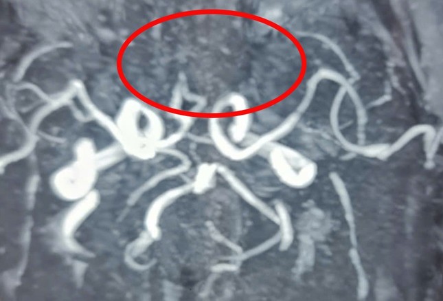 Người đàn ông bị đột quỵ não khi đang hát karaoke-1