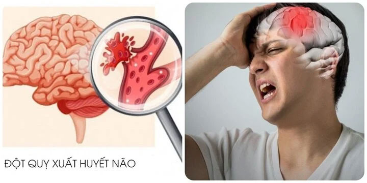 Đột quỵ não nguy hiểm thế nào?-1