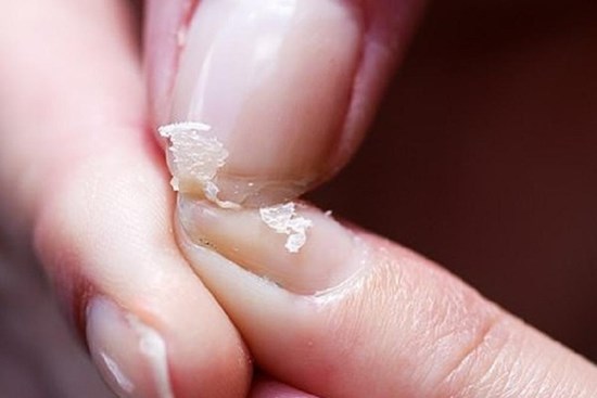 Nhìn móng tay để biết mình có bệnh hay không