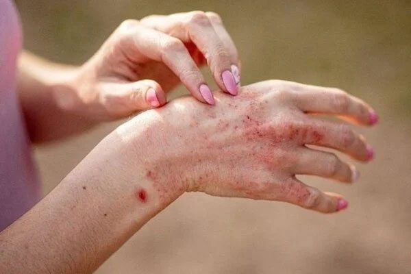 Những bệnh có thể bùng phát sau mưa lũ-1