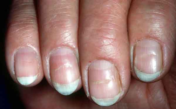 Cảnh báo những bệnh lý có thể phát hiện qua hình dáng móng tay-1