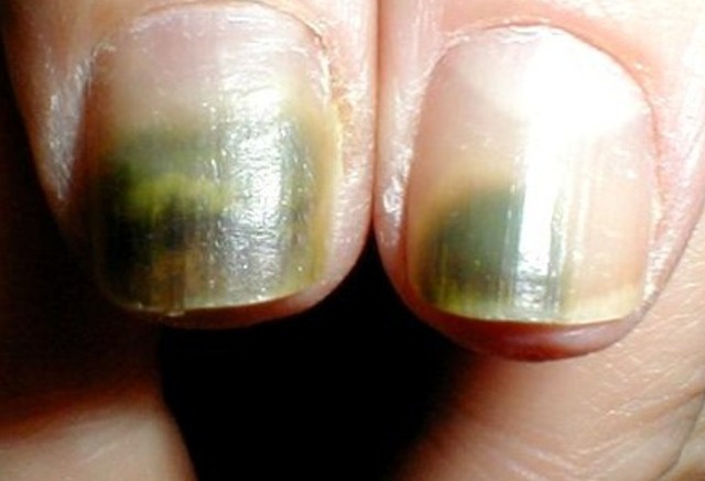 Cảnh báo những bệnh lý có thể phát hiện qua hình dáng móng tay-3