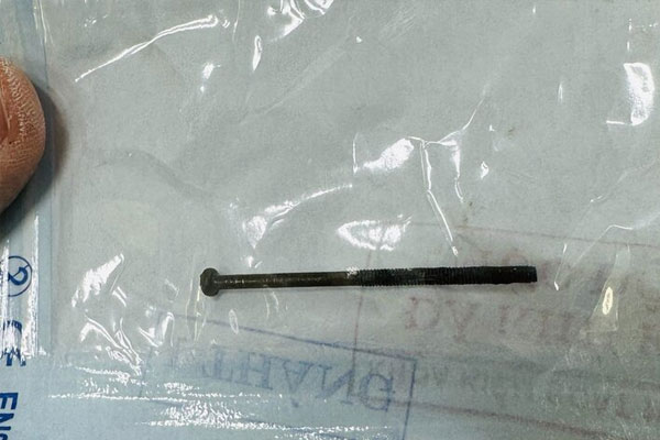 Gắp đinh vít dài 4 cm trong dạ dày bé trai 3 tuổi ở Quảng Ngãi-1