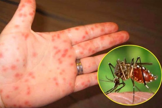 5 lưu ý cực kỳ quan trọng để phòng ngừa sốt xuất huyết sau mùa mưa lũ