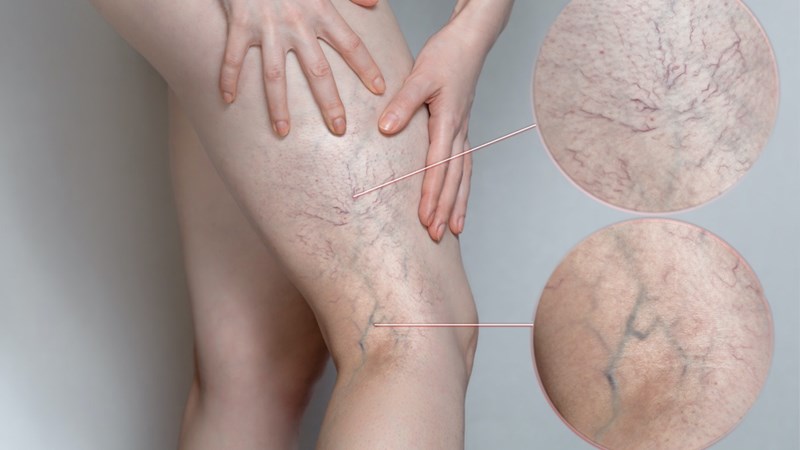 6 yếu tố làm tăng nguy cơ suy giãn tĩnh mạch chân-1