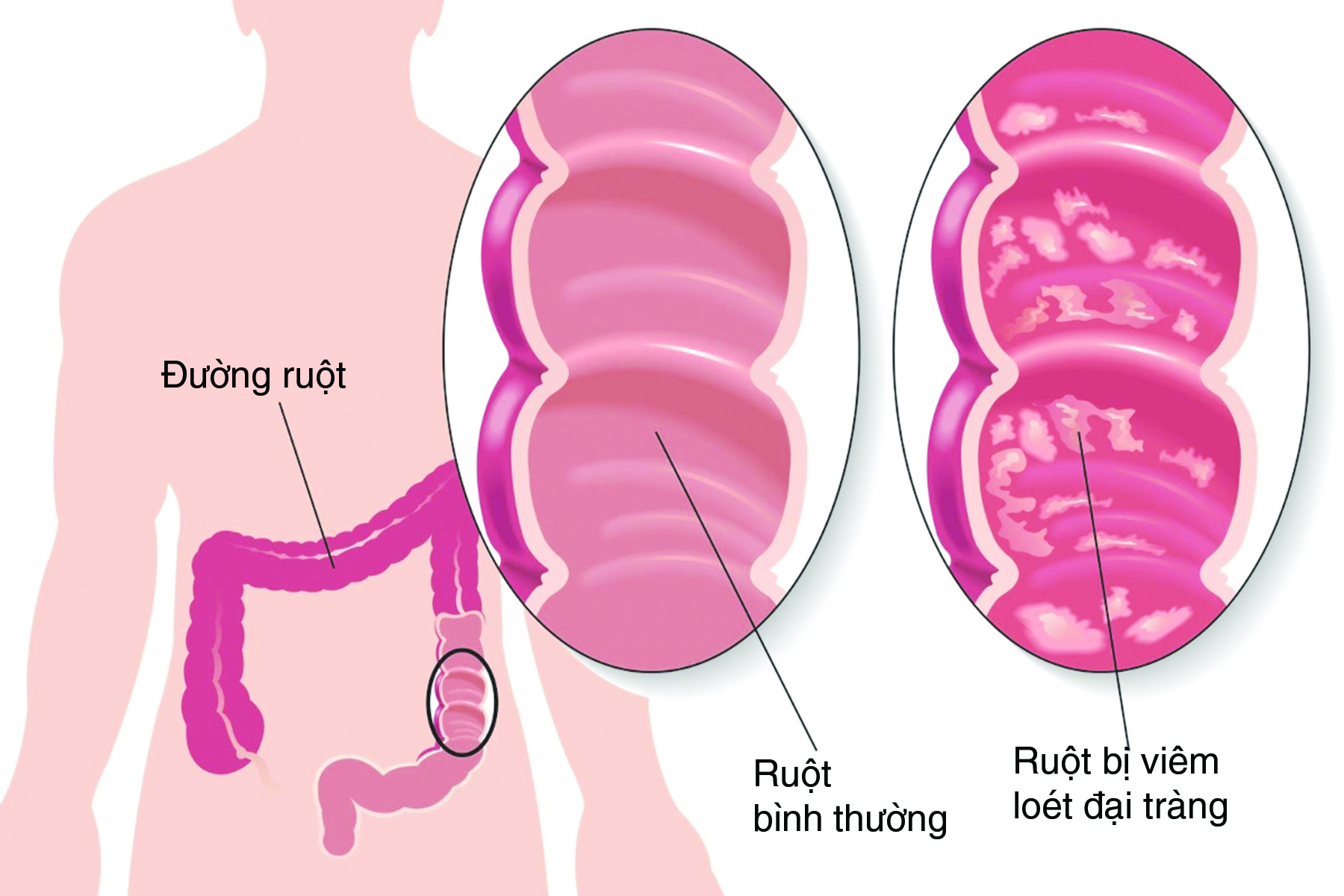 Viêm đại tràng mạn tính có nguy hiểm không?-1