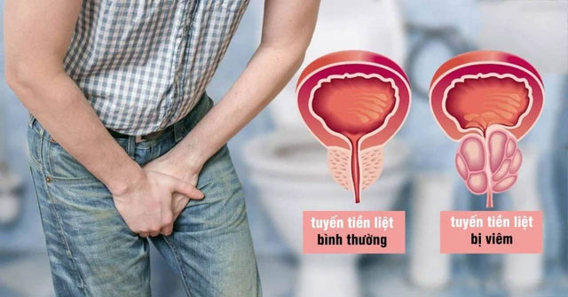 Người đàn ông 57 tuổi phát hiện ung thư tuyến tiền liệt ân hận vì một sai lầm nhiều người Việt mắc phải-2