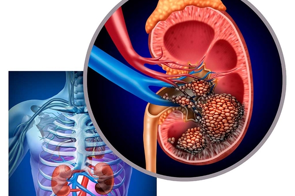 Người đàn ông 59 tuổi ở Quảng Ninh thoát khỏi ung thư thận nguy hiểm nhờ làm việc này hàng năm-3